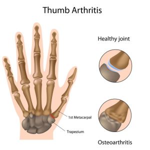 Dr David Stewart Hand & Wrist osteoarthritis