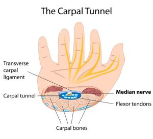 Dr David Stewart Carpal Tunnel Syndrome