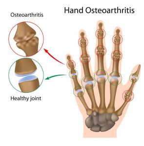 Dr David Stewart Hand & Wrist osteoarthritis